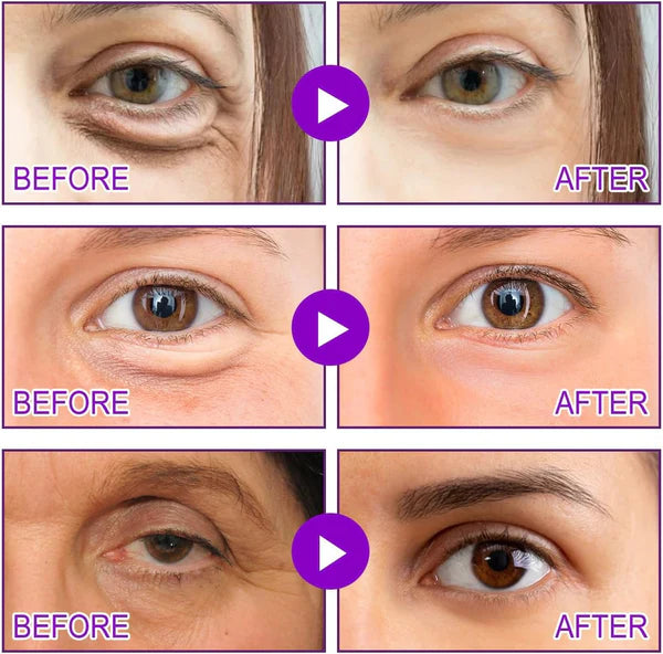 DERMELLE™ Lifting Microneedle Patches